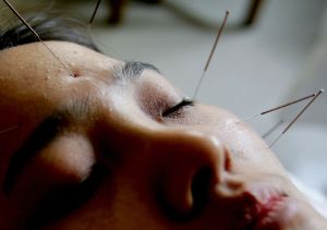 Woman getting acupuncture. An acupuncture patient was abandoned by their doctor